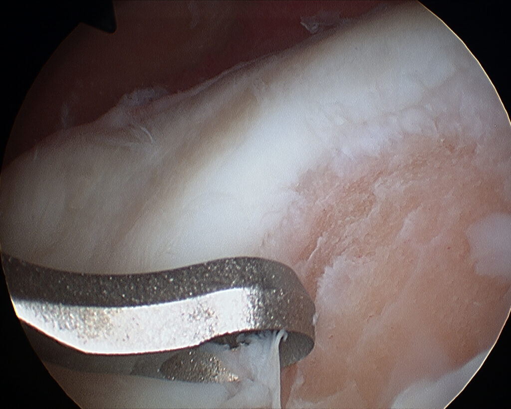 Bild 1 Knorpeldefekt