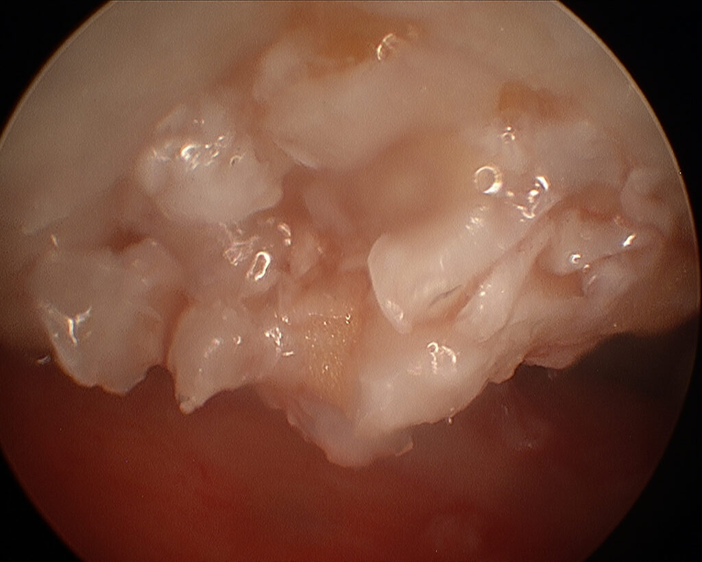 eingebrachte Knorpelchips