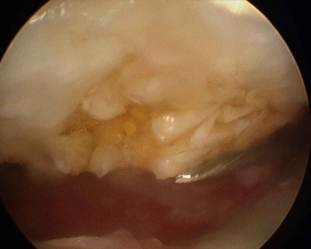 Nach dem Einbringen des Fibrinklebers