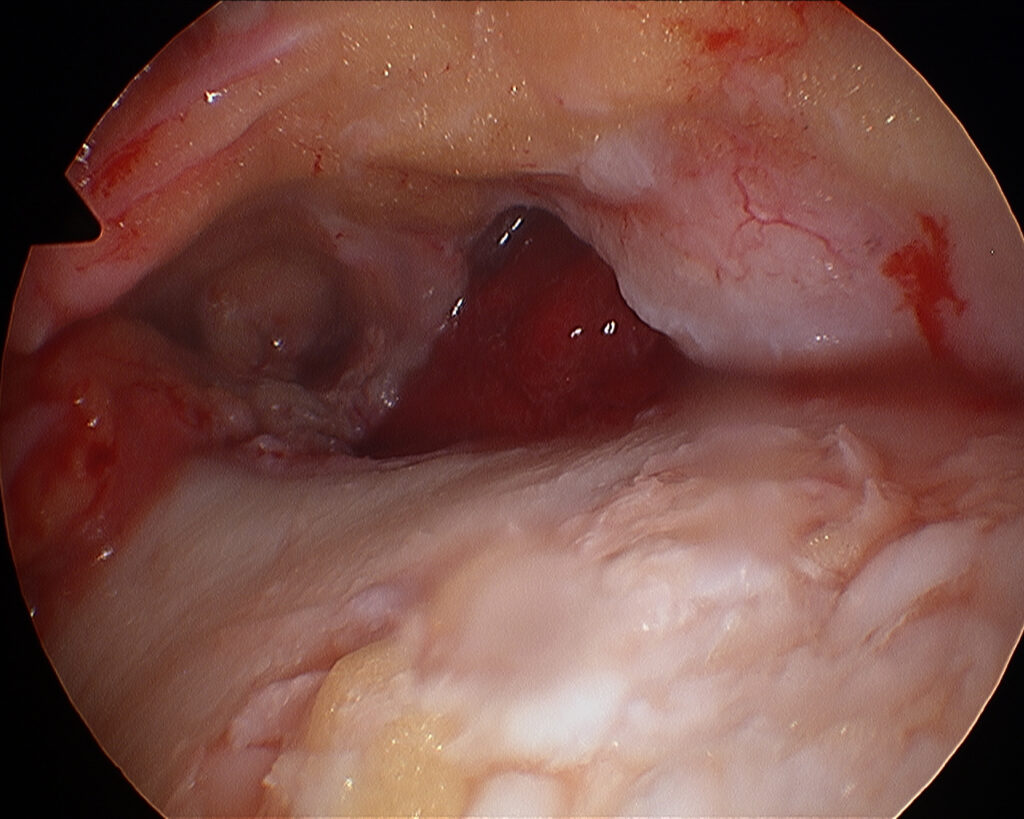 Bild 3 Knorpelchips einbringen